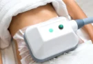 CoolSculpting: Easy Way to Lose Fat Without Surgery
